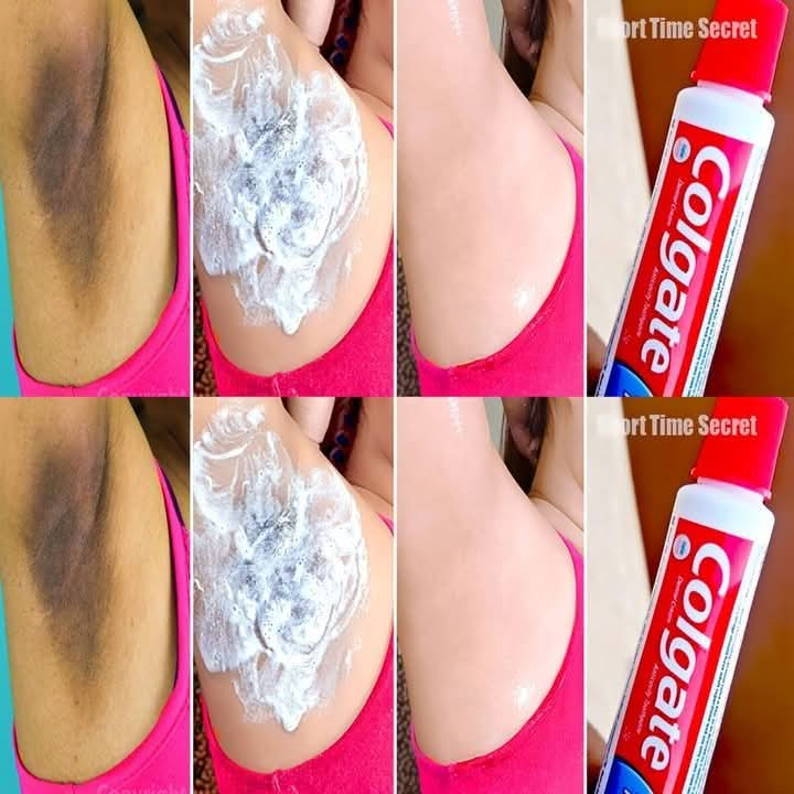 Say Goodbye to Dark Spots by Whitening Underarms with Toothpaste