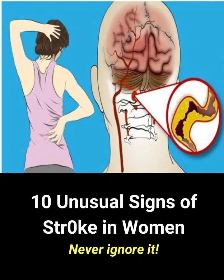 10 Unusual Signs of Str0ke in Women