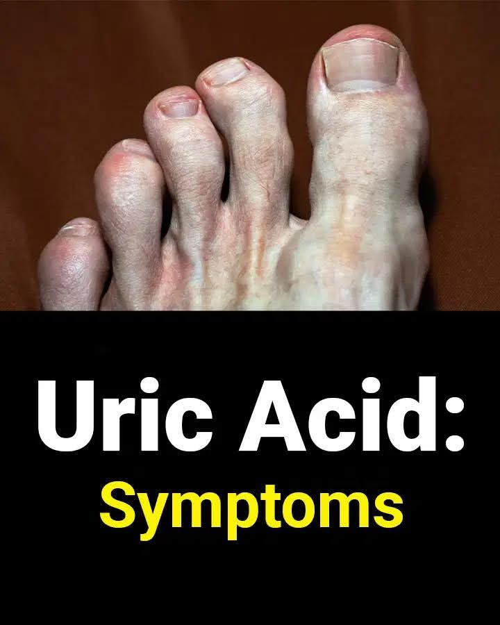 Diet and Uric Acid: What to Avoid to Prevent Gout