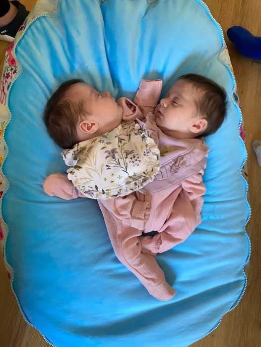These conjoined twin sisters were born joined at the chest and shared a liver, intestines, and other vital 0rgans . In addition, each sister had only one leg . When they were just 6 months old, doctors decided to separate them. The surgery lasted 18 hours, but the surgeons managed to successfully complete it . Today, the sisters are 3 years old. Curious to see what the twins look like after all these years? Their post-separation photos were shown in the first comment