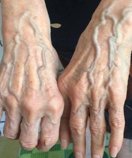 If your veins are visible in your hand, it is a signal of ca…. See more