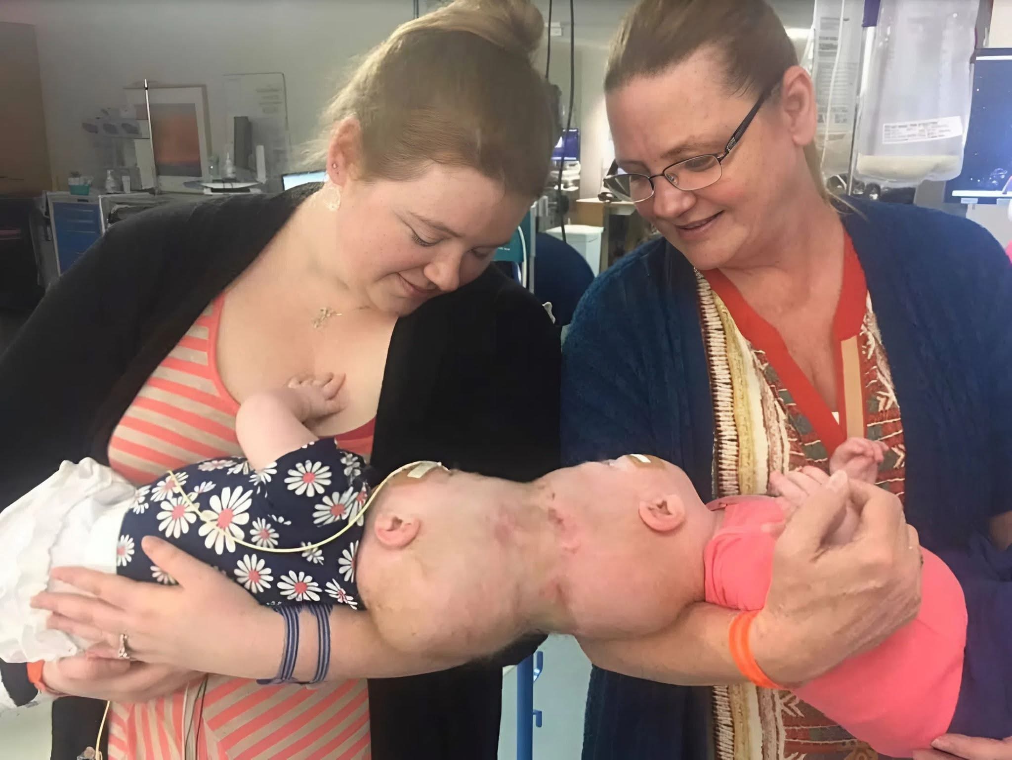 These Siamese sisters were born with their heads joined  The separation surgery was very complex, as doctors had to separate not only the skull bones but also the brain  The girls were only 10 months old when doctors separated them, and fortunately, the surgery was successful Today, the girls are 9 years old. Of course, their development is slightly different from that of their peers, but overall they live like normal children  Curious to see what the sisters look like today? Their photos after the separation are in the first comment  See less