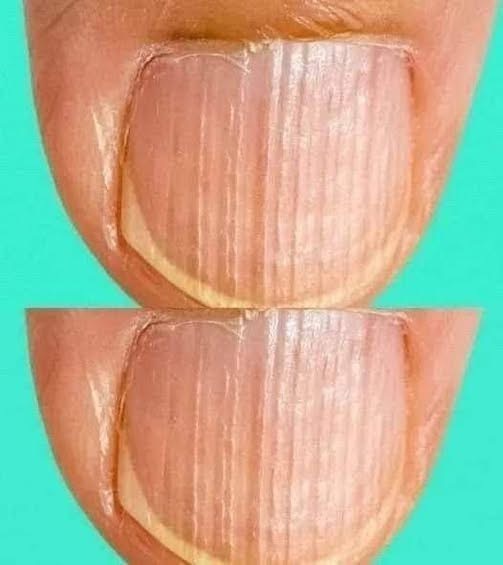 🤔Having Striped Nails Could Mean That Your Body Is… More Details below👇