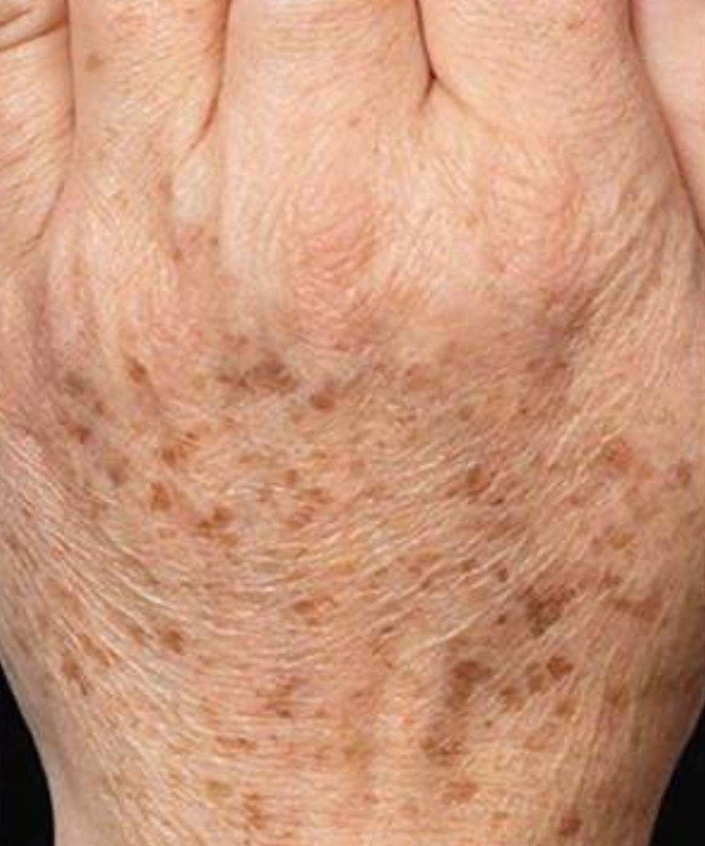 “Did you know that if you get SPOTS on your HANDS it is a sign that you suffer from Check 1st comment 👇”