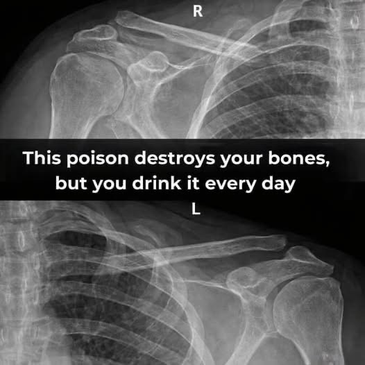 This poison destroys your bones, but you drink it every day! You surely didn’t know this! Find Out in the first comment