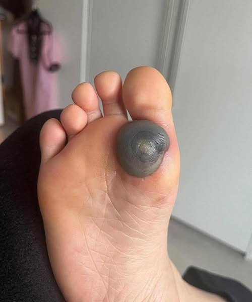 My daughter woke up with this huge spot on her foot I don’t know what it could be. She’s been in pain and can’t move her foot what is this.. Explain this 😩