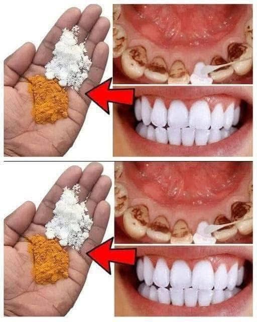 Teeth whitening in just 2 minutes – turning yellow and accumulated tartar into milk-like white and shiny. Full recipe in the first comment 💬👀
