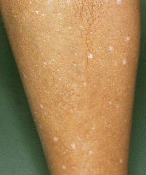 Have you noticed small white spots on your arms or legs… and you don’t know what they are? Here’s what a specialist says check 1st comment👇…