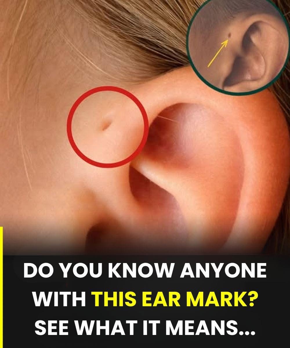 People with this ear hole have… See below👇