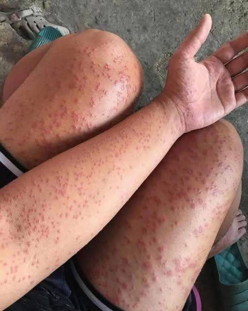 I Slept at my friends old apartment for a couple days noticed these weird bump…See below