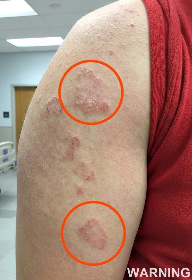 If you see red marks appearing on your arm, that’s a sign of ca… See below👇