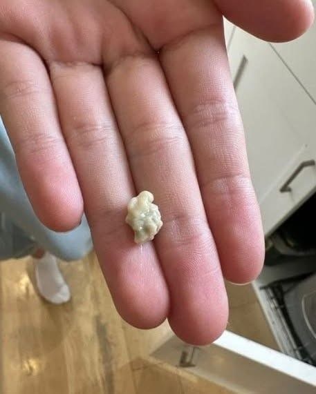 Those Small White Bumps in the Throat May Be Tonsil Stones – Here’s What to Know 😨