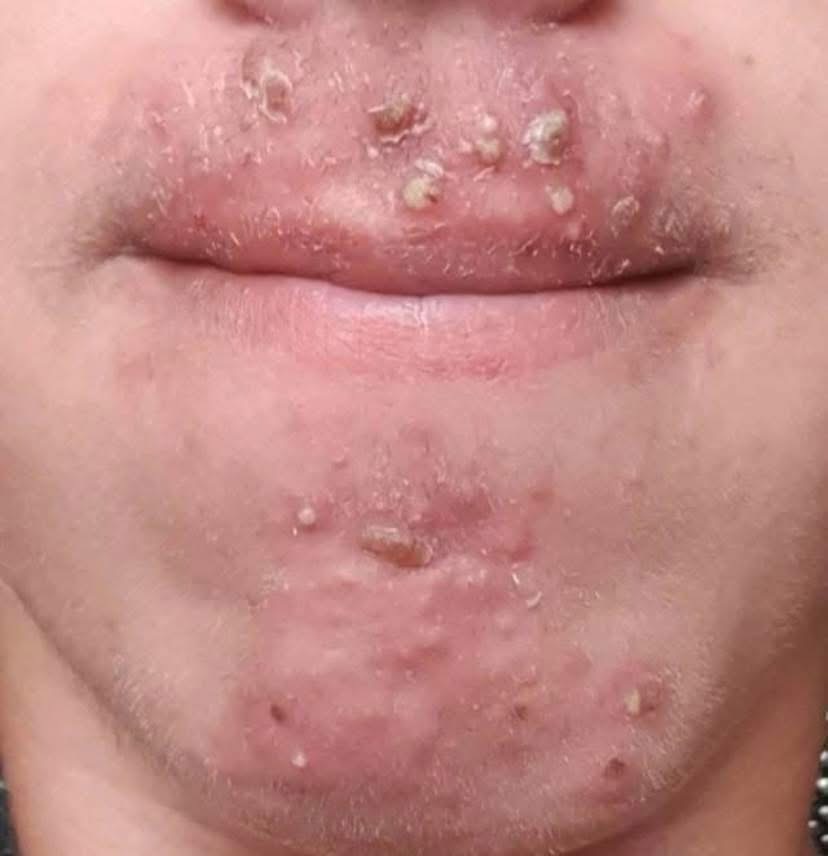 Been dating this woman I met at Walmart and after finally getting some I woke up with these on my face what is this?😫