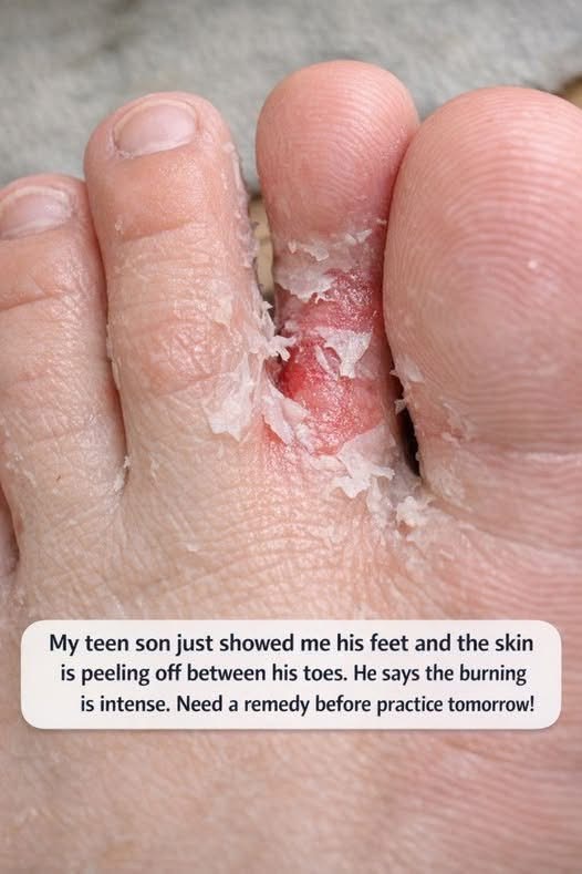 My teen son just showed me his feet and the skin is peeling off between his toes. He says the burning is intense. Need a remedy before practice tomorr. Full article 👇 💬