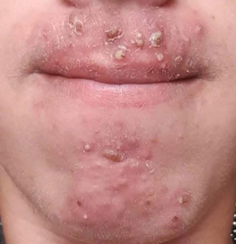 Been dating this woman I met at Walmart and after finally getting some I woke up with these on my face what is this?😫