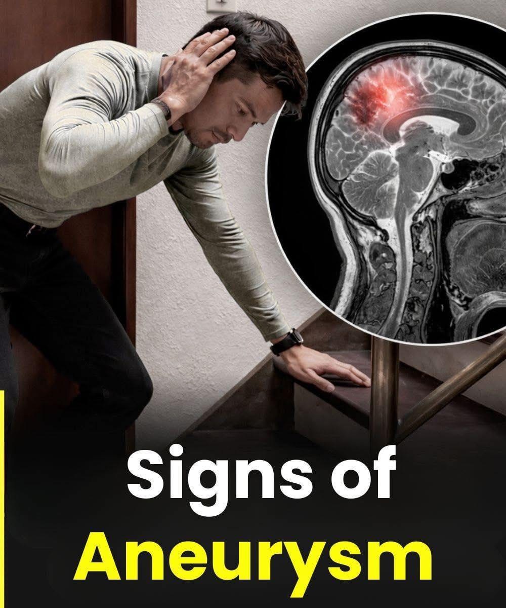 Signs of Aneurysm…See more in 1st comment ⬇️⬇️😱🤔😱