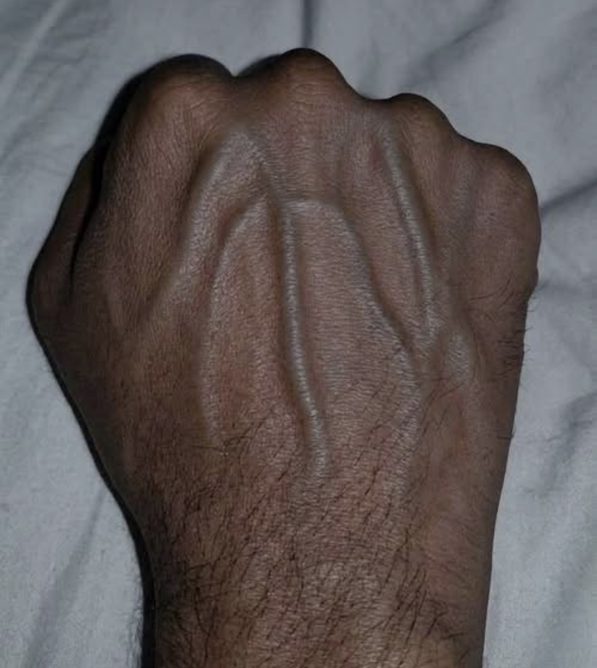 If your veins are visible in your hand, it is a signal of ca… 😳👇