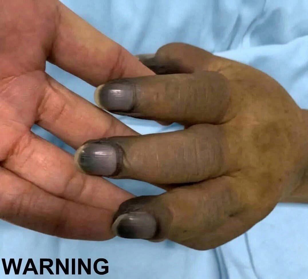 These are the consequences of painting your nails with… See below