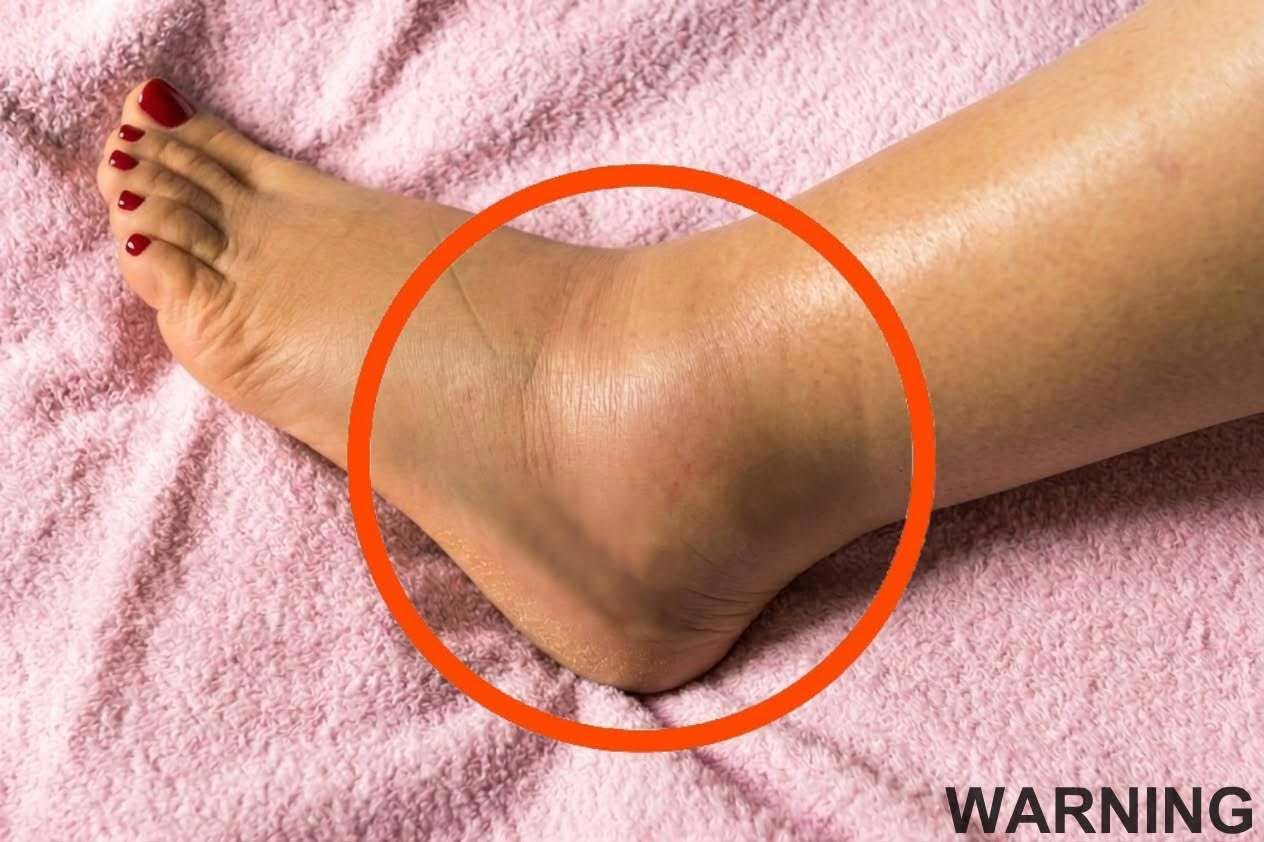 If you notice your legs are swollen, that’s a sign of ca… See below👇