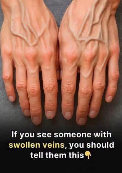 If you have visible veins it means you are… check 1st comment