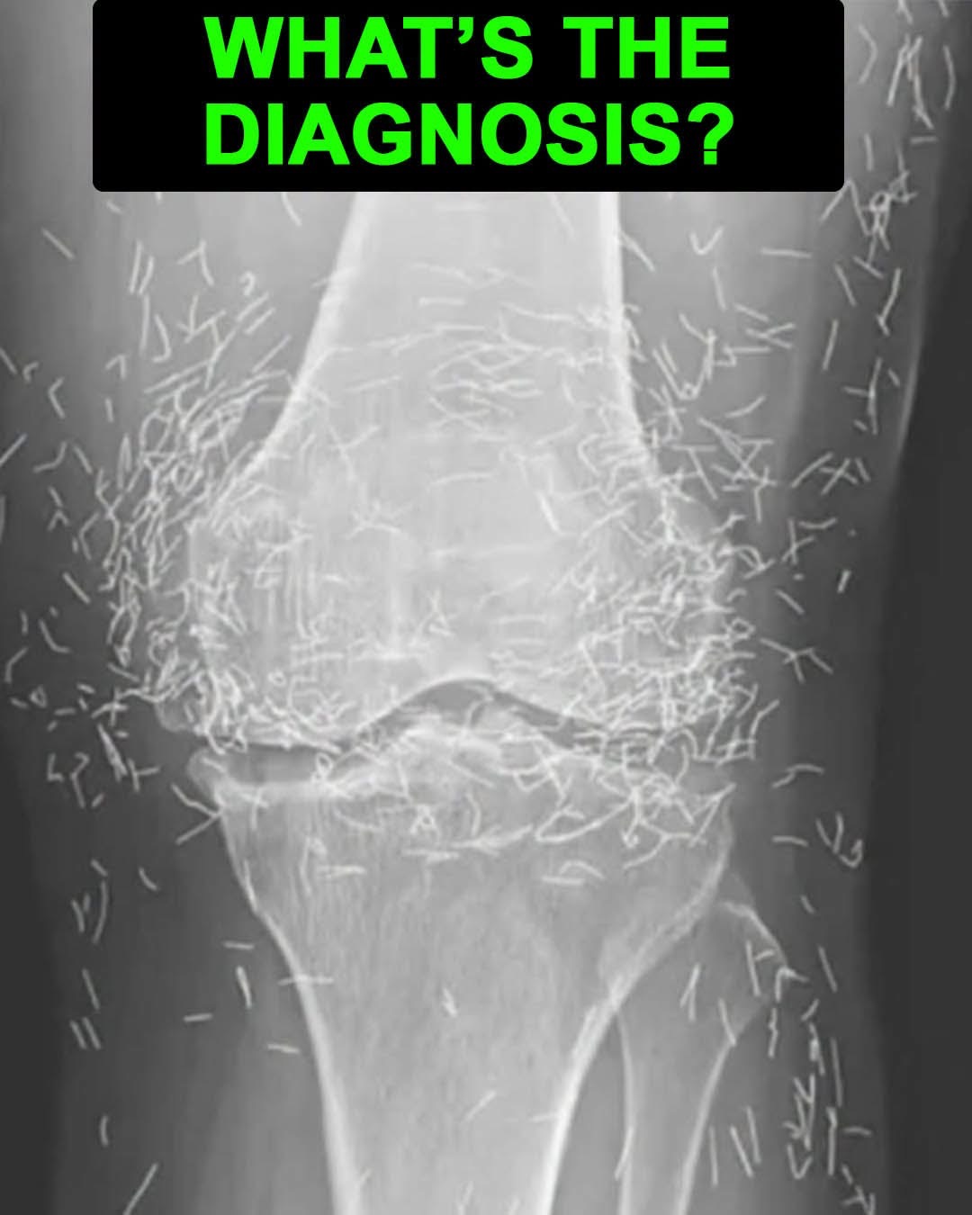 Caption: A 65-year-old woman came to the clinic after experiencing months of chronic knee pain. Despite trying multiple treatments including traditional Chinese medicine she found no relief. This X-ray was taken during her visit. What do you think is the diagnosis.  Answer in the comments 👇