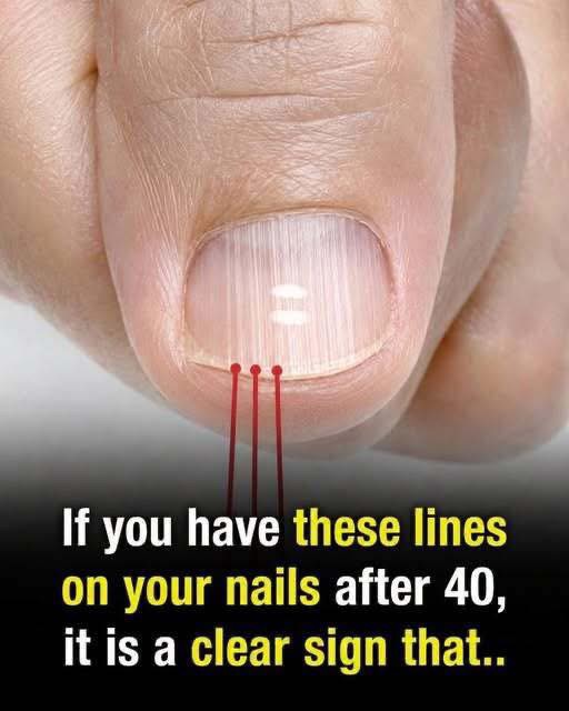 If you have these lines on your nails after 40, it is a clear sign that..