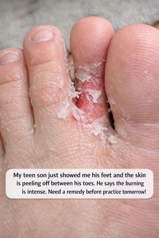 My teen son just showed me his feet and the skin is peeling off between his toes. He says the burning is intense. Need a remedy before practice tomorr. Full article 👇 💬