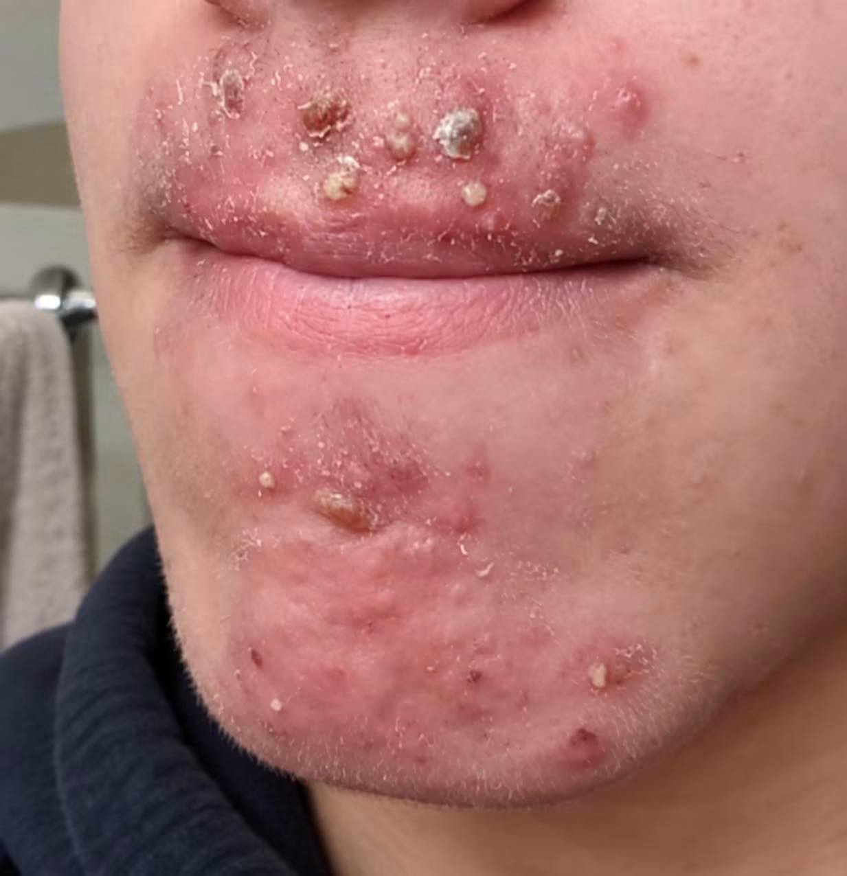 Been seeing this woman I met at Walmart, and after finally getting some, I woke up with these on my face—what are they? 😫 ​﻿⠀​­ﾠ